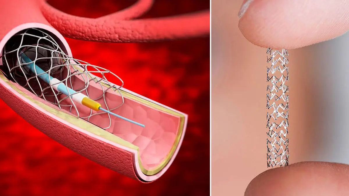 auditoria sobre colocacion de stents coronarios - Cuál es la vida util de un stent