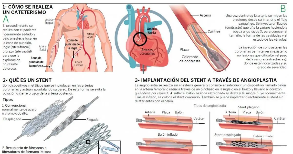 auditoria sobre necesidad de colocacion de stents coronarios - Cuánto sale un stent coronario en Argentina 2024