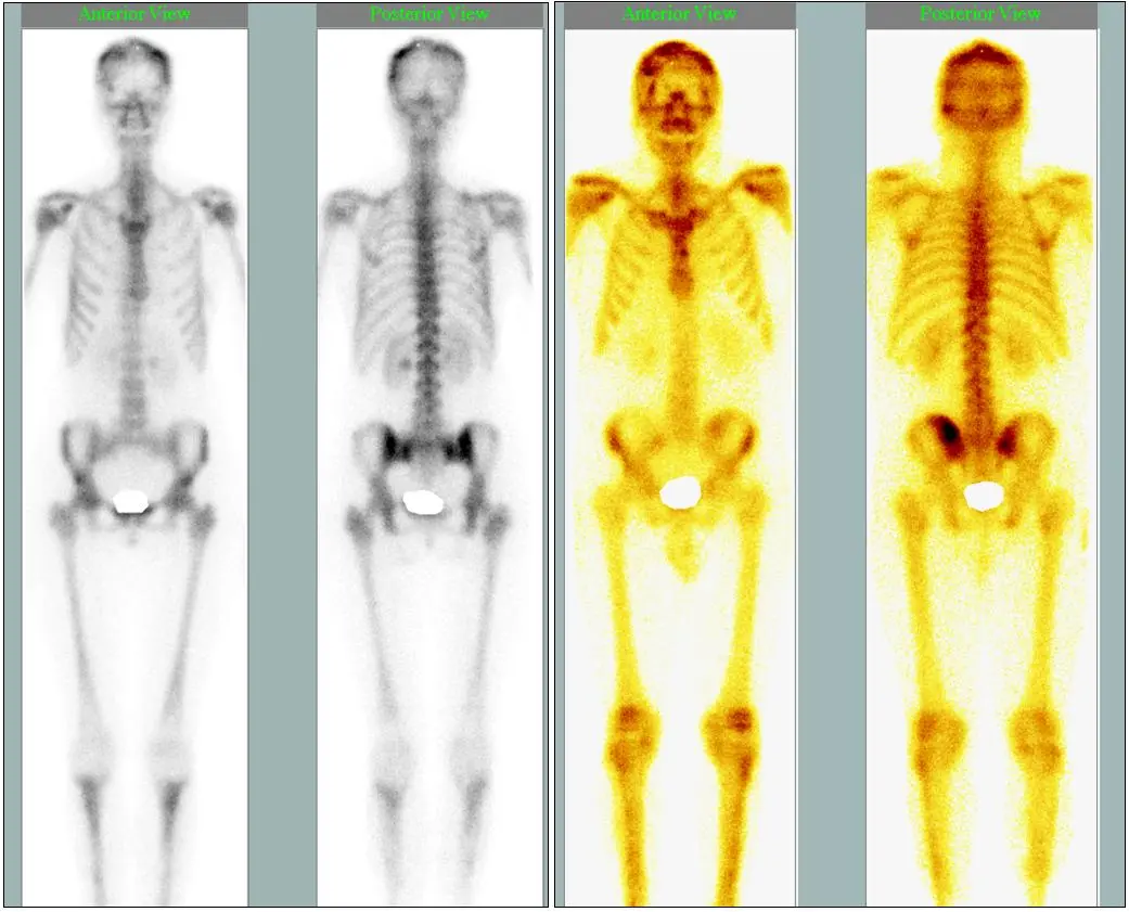 centellograma oseo total auditoria - Qué diagnóstica un centellograma óseo