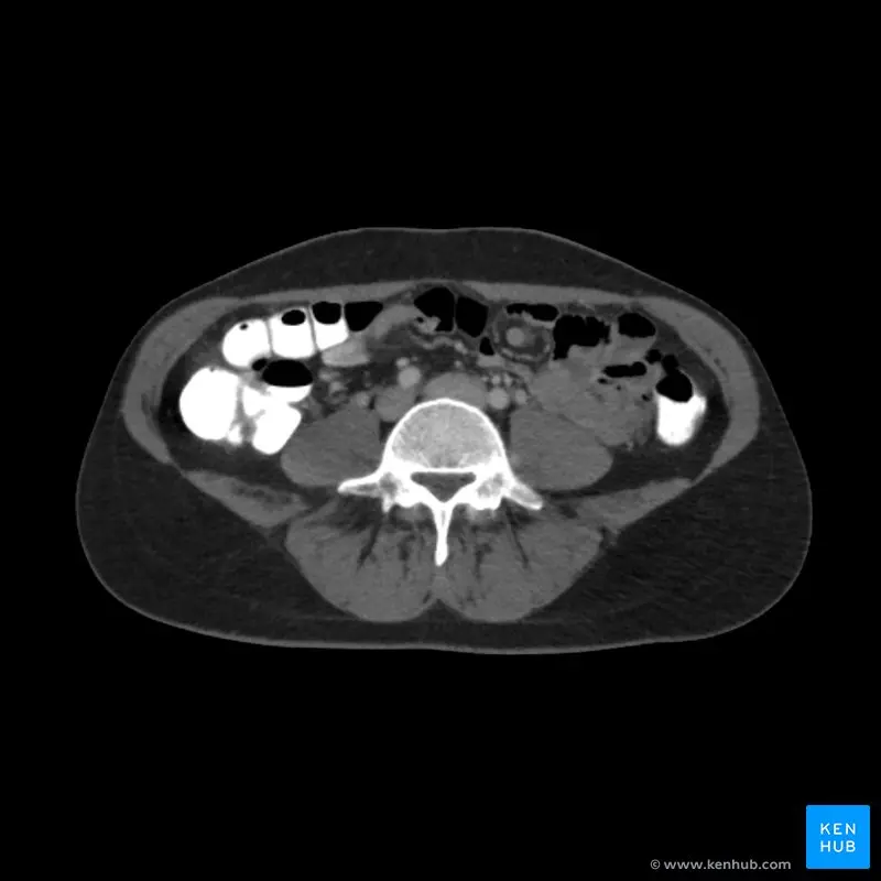 tomografia de abdomen norma de auditoria - Qué es una tomografía computarizada como guía para procedimientos