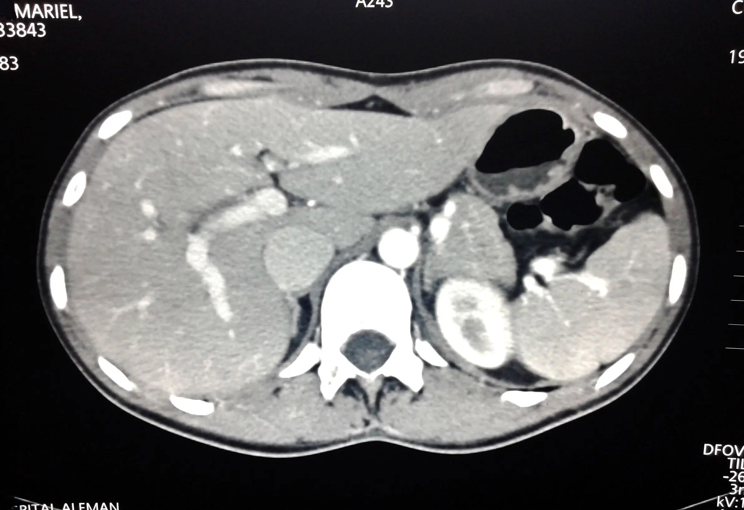 tomografia de abdomen completa auditoria - Qué fases existen en el TC abdominal