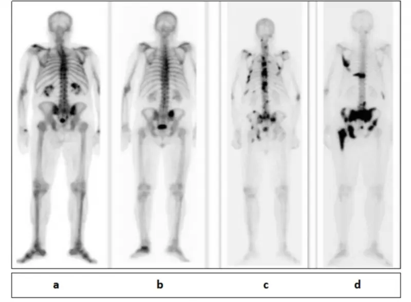 centellograma oseo total auditoria - Qué hacer después de un centellograma óseo