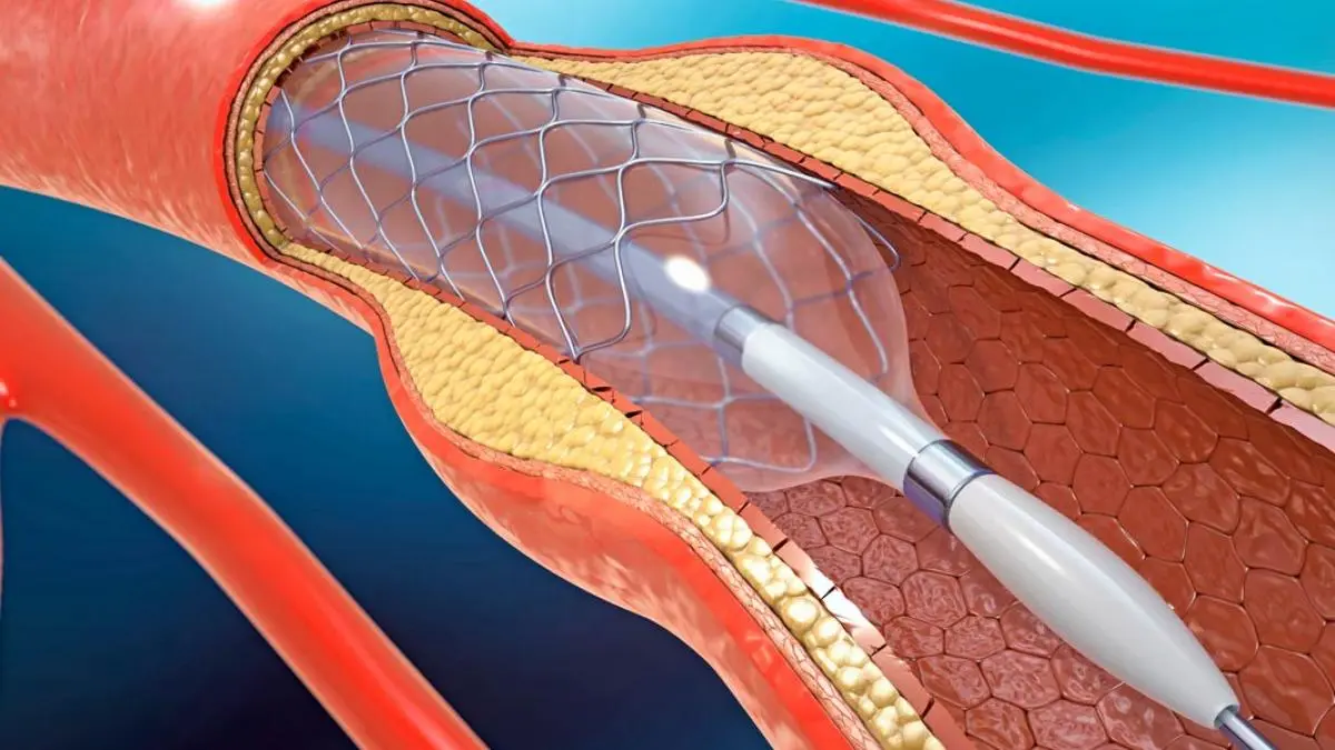 auditoria sobre colocacion de stents coronarios - Qué problemas puede dar un stent