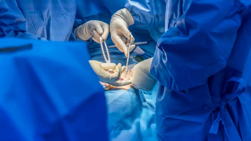auditoria medica em cirurgias de hernia inguinal - Qué secuelas deja una operacion de hernia inguinal